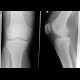 Pellegrini Stieda: X-ray - Plain radiograph